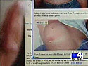 INFLAMMATORY BREAST CANCER |  Tia Mary,Thank you for posting the information on inflammatory breast...