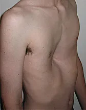 Hollow chest pattern adjustment |  I need to make a hollow chest adjustment on a sleeveless, round necked, top and...